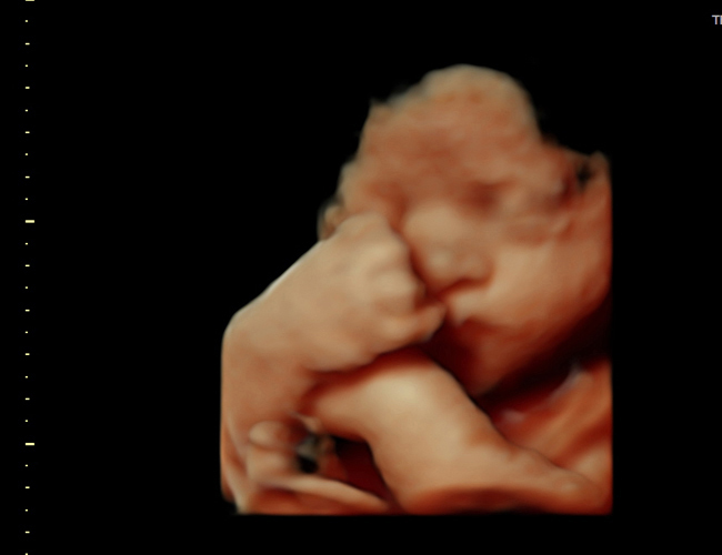 3D ultrasound image at 31 weeks